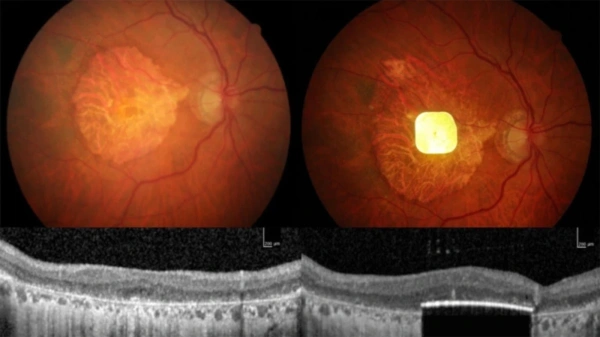 AI Implants Restore Vision and Speech to Humans